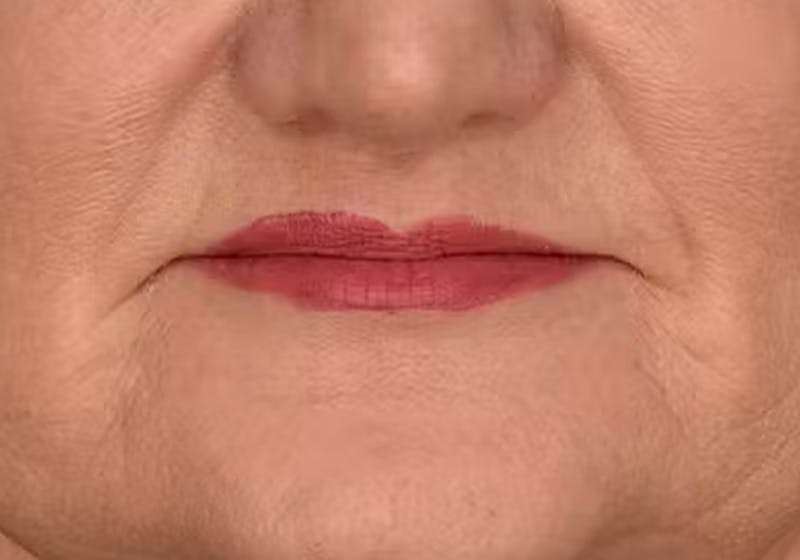 Lip Lift Before & After Gallery - Patient 295227 - Image 2