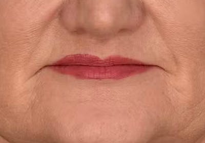 Lip Lift Before & After Gallery - Patient 295227 - Image 2