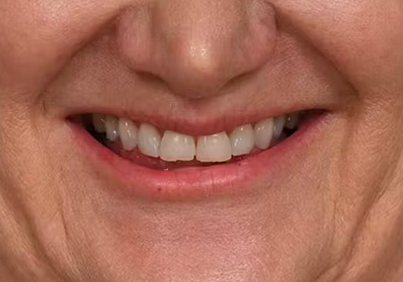 Lip Lift Before & After Gallery - Patient 295227 - Image 3