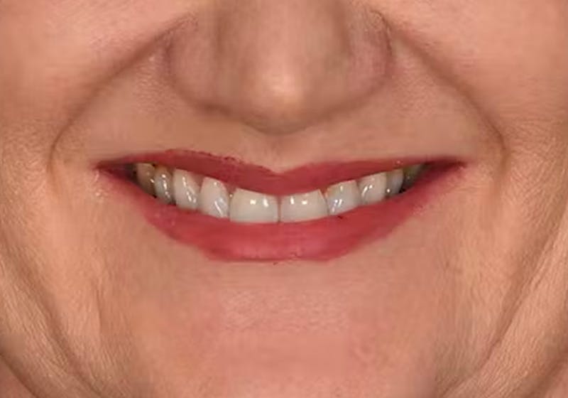 Lip Lift Before & After Gallery - Patient 295227 - Image 4
