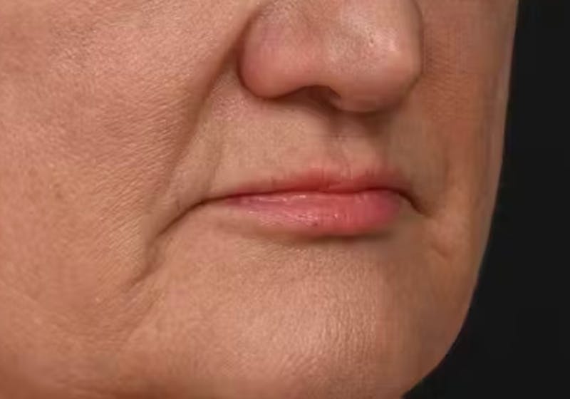 Lip Lift Before & After Gallery - Patient 295227 - Image 5