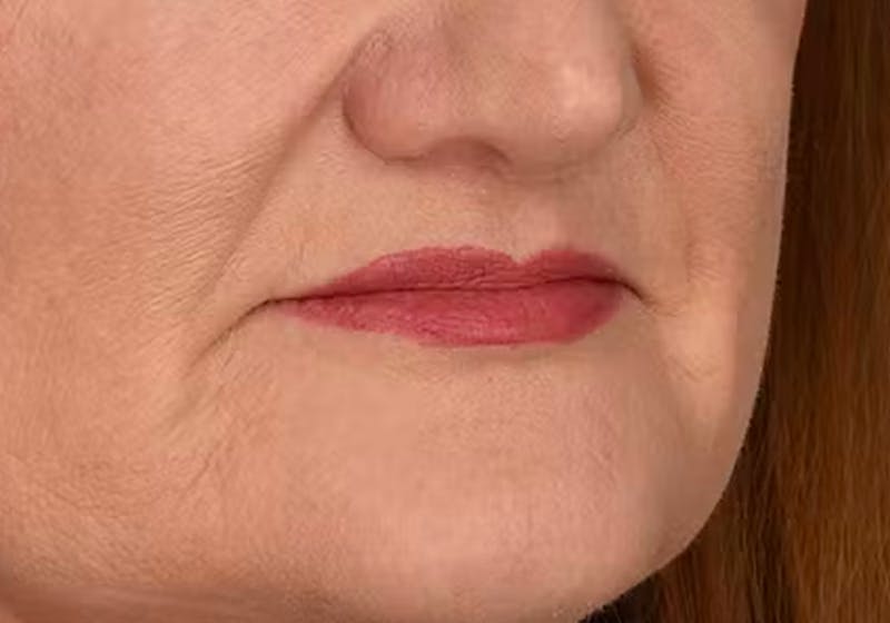 Lip Lift Before & After Gallery - Patient 295227 - Image 6