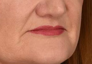 Lip Lift Before & After Gallery - Patient 295227 - Image 6