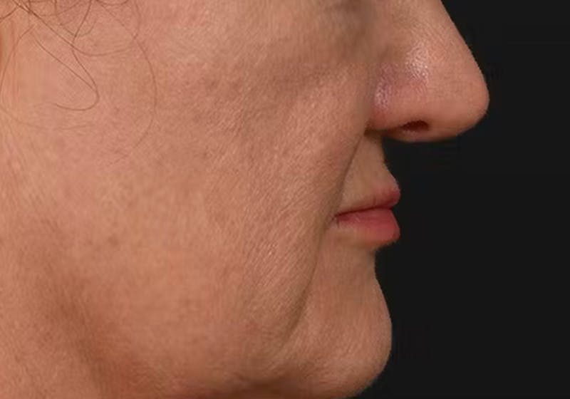 Lip Lift Before & After Gallery - Patient 295227 - Image 7
