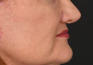 Lip Lift Before & After Gallery - Patient 295227 - Image 8