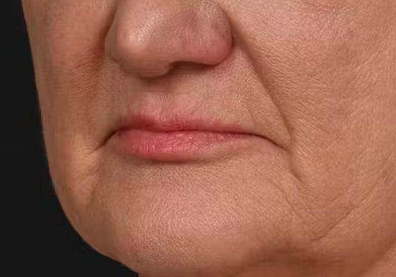 Lip Lift Before & After Gallery - Patient 295227 - Image 9