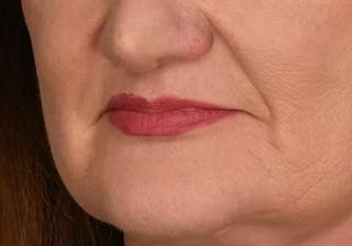 Lip Lift Before & After Gallery - Patient 295227 - Image 10