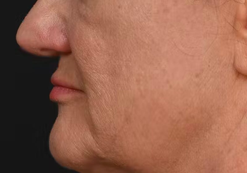 Lip Lift Before & After Gallery - Patient 295227 - Image 11