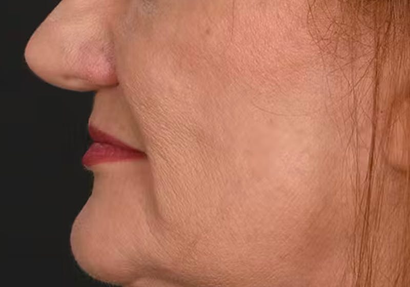 Lip Lift Before & After Gallery - Patient 295227 - Image 12