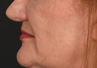 Lip Lift Before & After Gallery - Patient 295227 - Image 12