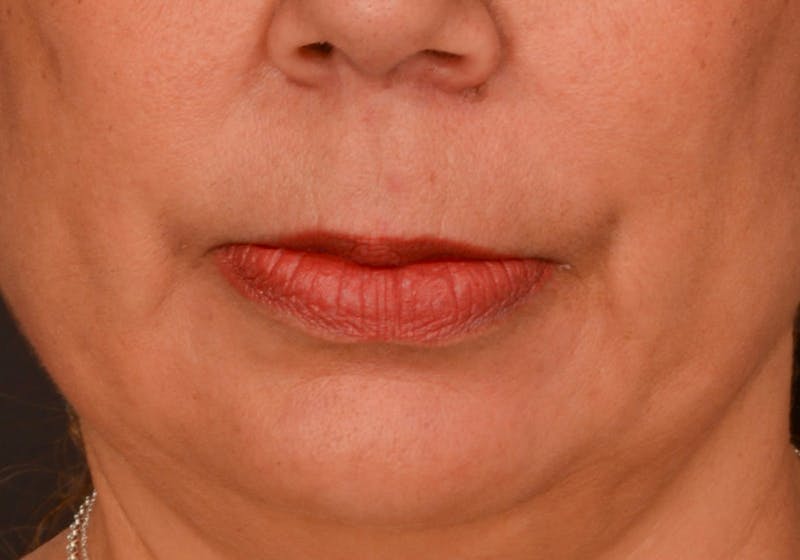 Lip Lift Before & After Gallery - Patient 728432 - Image 1