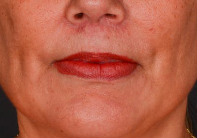 Lip Lift Before & After Gallery - Patient 728432 - Image 2