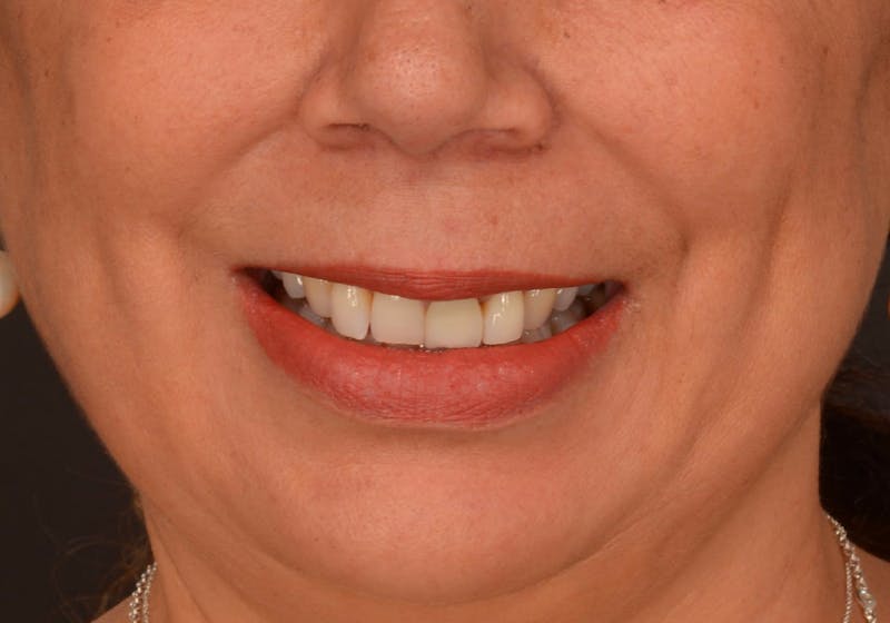 Lip Lift Before & After Gallery - Patient 728432 - Image 3