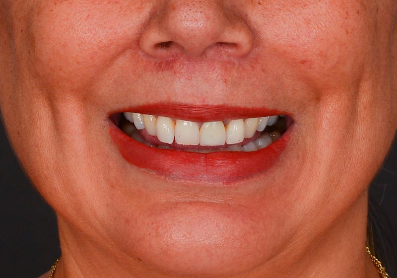 Lip Lift Before & After Gallery - Patient 728432 - Image 4