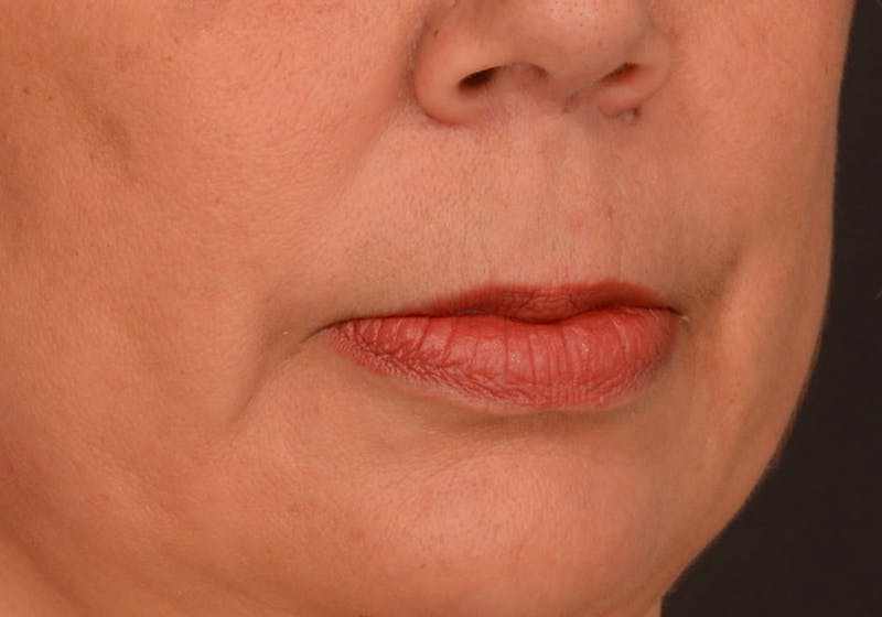Lip Lift Before & After Gallery - Patient 728432 - Image 5