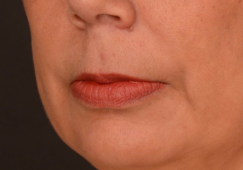 Lip Lift Before & After Gallery - Patient 728432 - Image 7