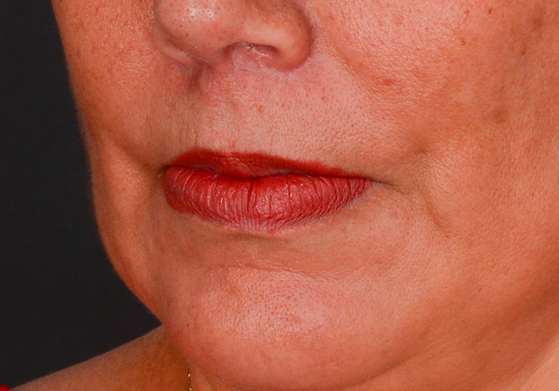 Lip Lift Before & After Gallery - Patient 728432 - Image 8