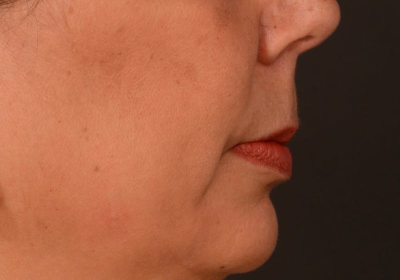 Lip Lift Before & After Gallery - Patient 728432 - Image 9