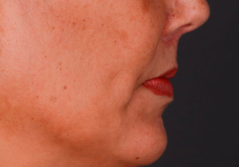 Lip Lift Before & After Gallery - Patient 728432 - Image 10