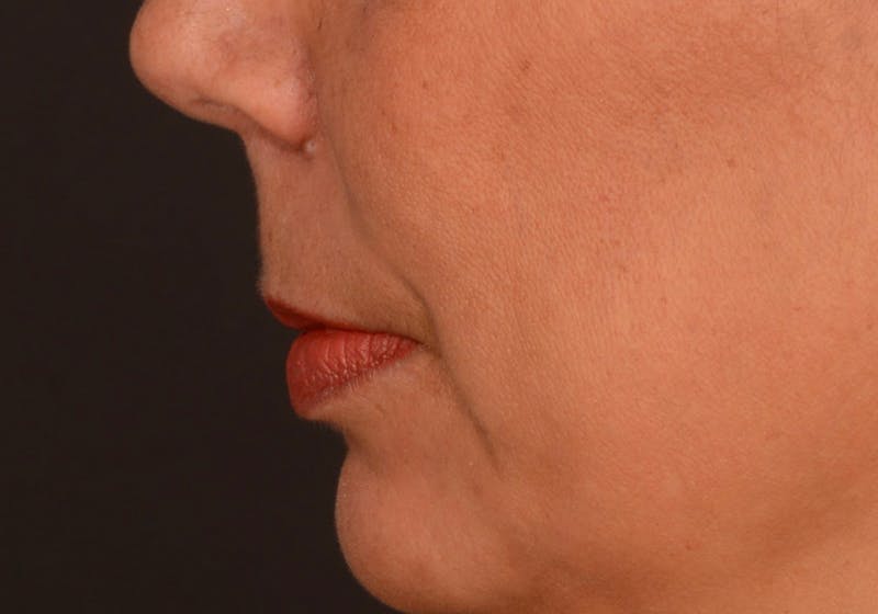 Lip Lift Before & After Gallery - Patient 728432 - Image 11