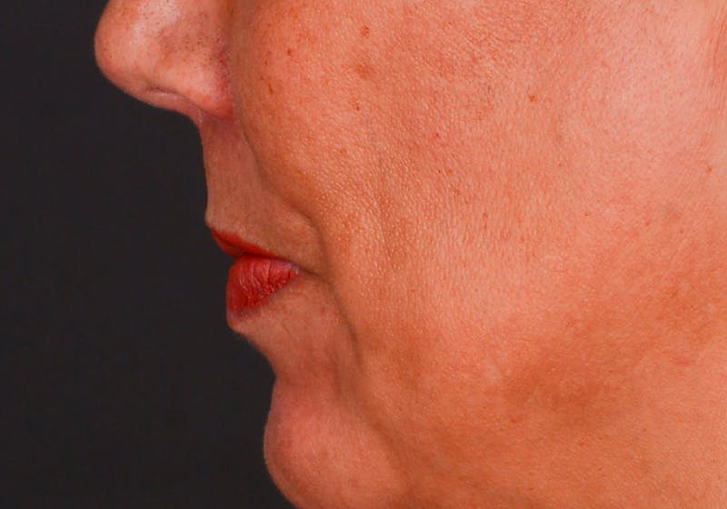 Lip Lift Before & After Gallery - Patient 728432 - Image 12