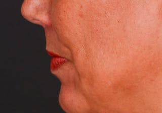Lip Lift Before & After Gallery - Patient 728432 - Image 12