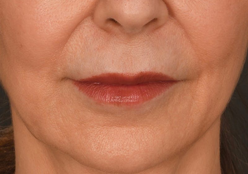 Lip Lift Before & After Gallery - Patient 340717 - Image 1