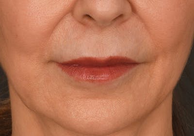 Lip Lift Before & After Gallery - Patient 340717 - Image 1