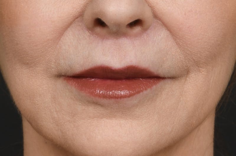 Lip Lift Before & After Gallery - Patient 340717 - Image 2