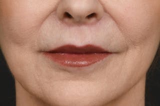 Lip Lift Before & After Gallery - Patient 340717 - Image 2