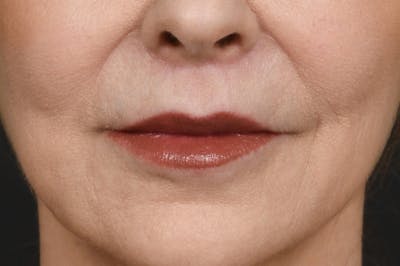 Lip Lift Before & After Gallery - Patient 340717 - Image 2
