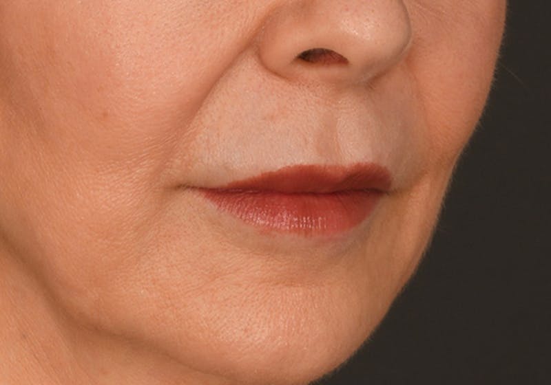 Lip Lift Before & After Gallery - Patient 340717 - Image 3