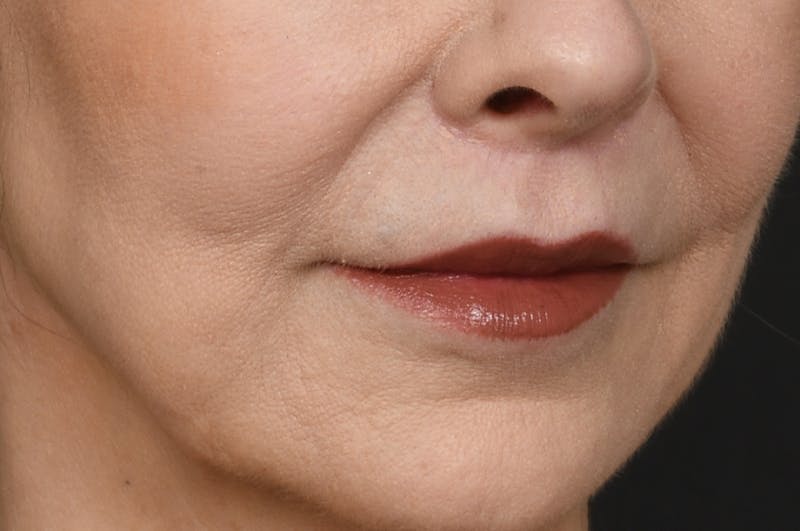 Lip Lift Before & After Gallery - Patient 340717 - Image 4