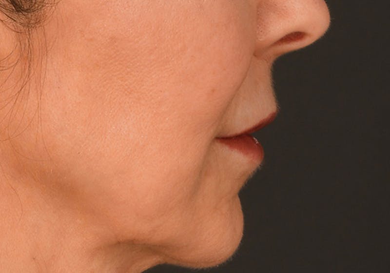 Lip Lift Before & After Gallery - Patient 340717 - Image 5