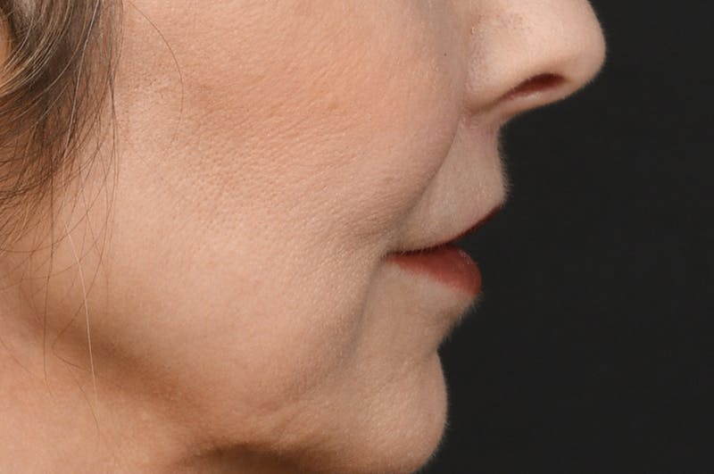 Lip Lift Before & After Gallery - Patient 340717 - Image 6