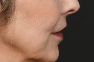 Lip Lift Before & After Gallery - Patient 340717 - Image 6