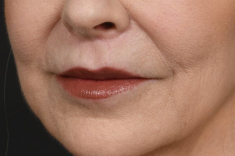 Lip Lift Before & After Gallery - Patient 340717 - Image 7