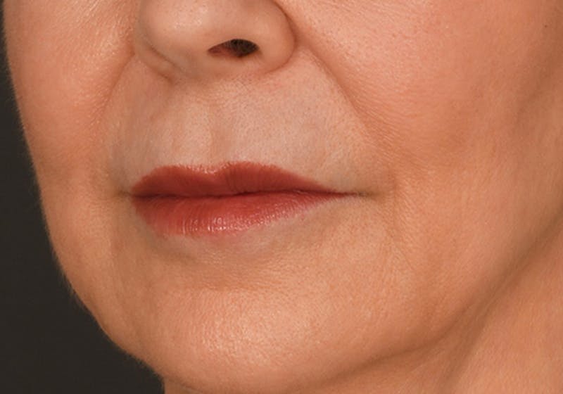 Lip Lift Before & After Gallery - Patient 340717 - Image 8