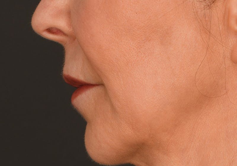 Lip Lift Before & After Gallery - Patient 340717 - Image 9