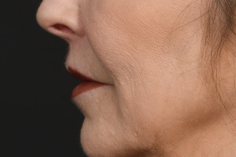 Lip Lift Before & After Gallery - Patient 340717 - Image 10