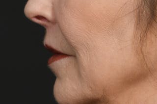 Lip Lift Before & After Gallery - Patient 340717 - Image 10