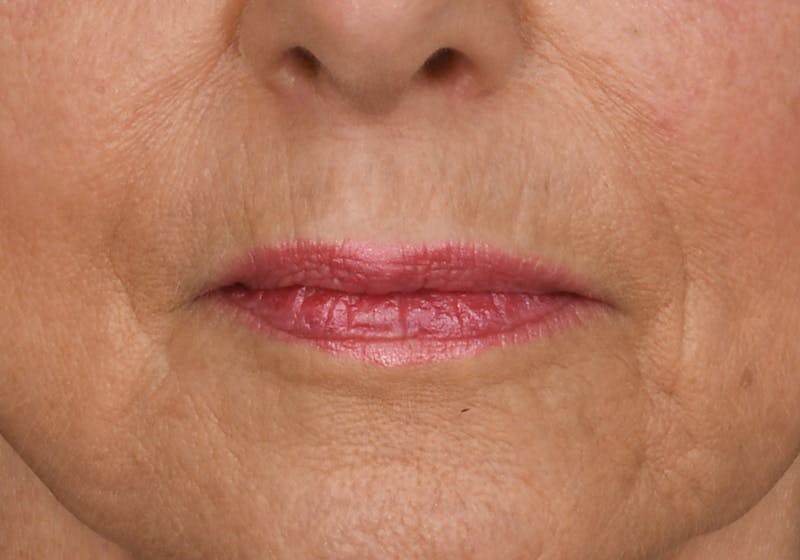 Lip Lift Before & After Gallery - Patient 429445 - Image 1