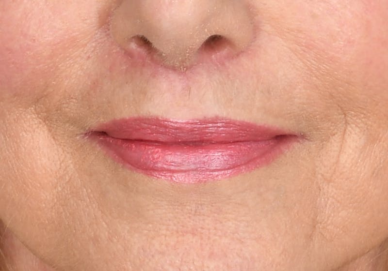 Lip Lift Before & After Gallery - Patient 429445 - Image 2
