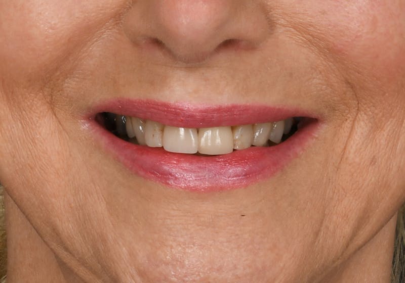 Lip Lift Before & After Gallery - Patient 429445 - Image 3