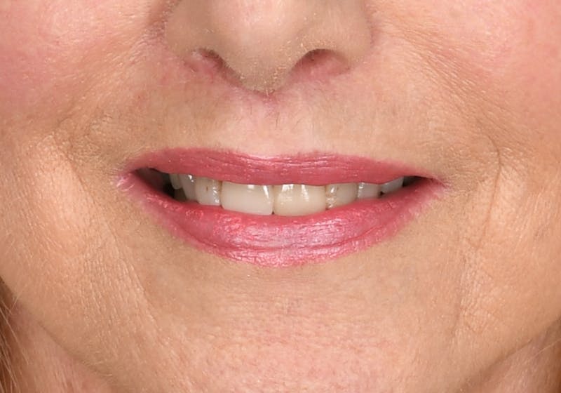 Lip Lift Before & After Gallery - Patient 429445 - Image 4