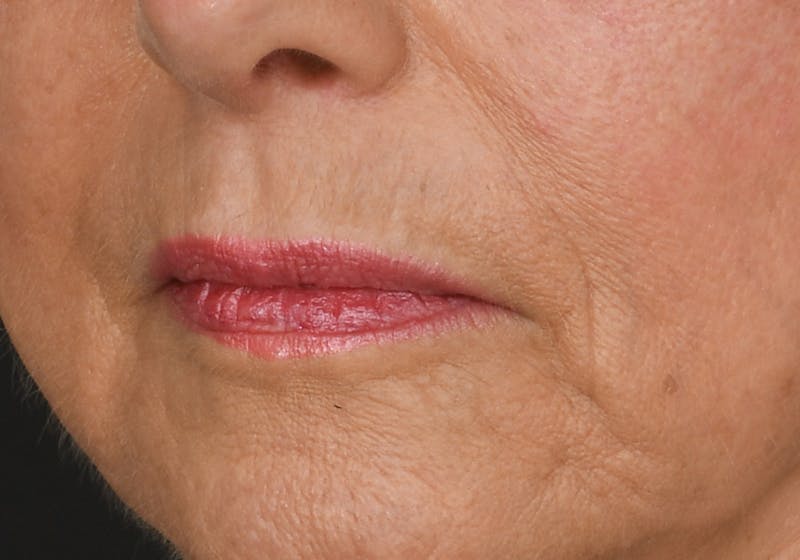 Lip Lift Before & After Gallery - Patient 429445 - Image 5