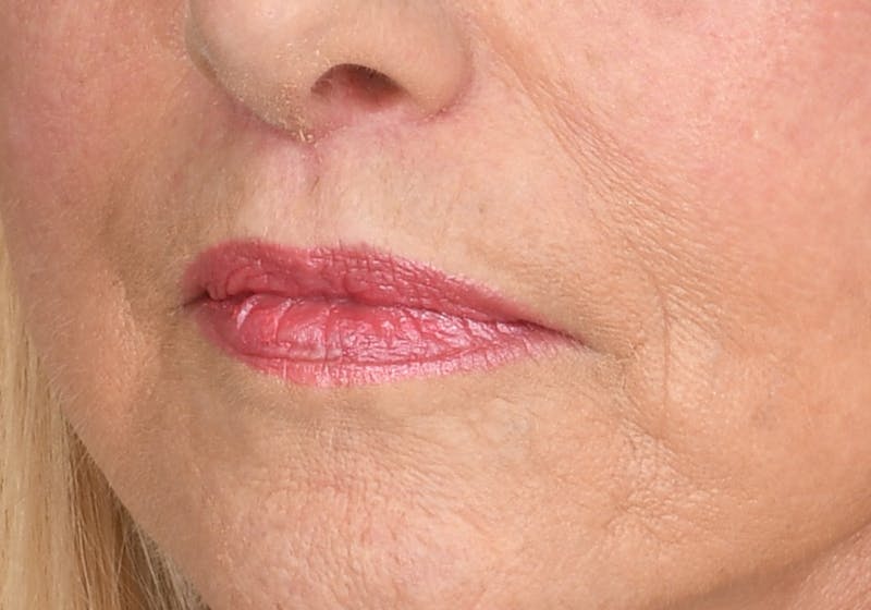 Lip Lift Before & After Gallery - Patient 429445 - Image 6
