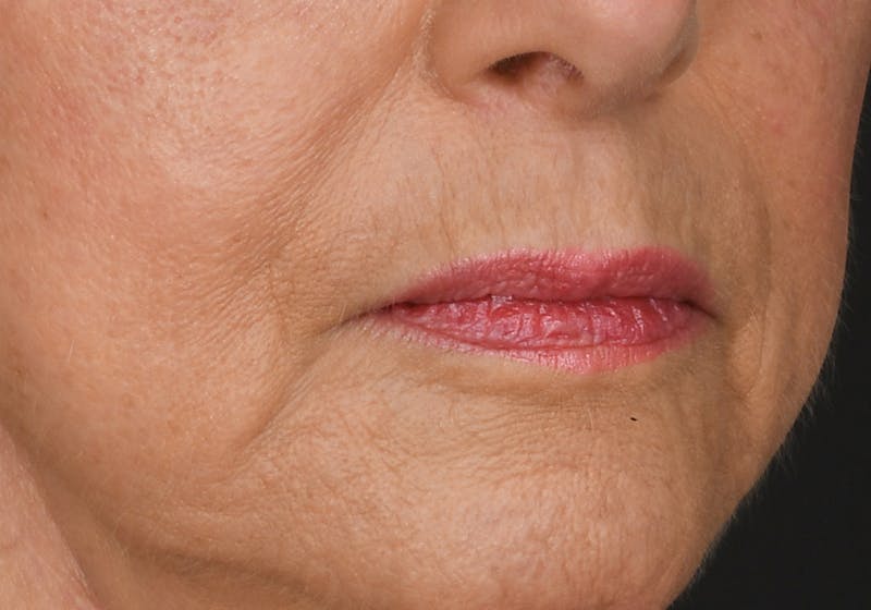 Lip Lift Before & After Gallery - Patient 429445 - Image 7