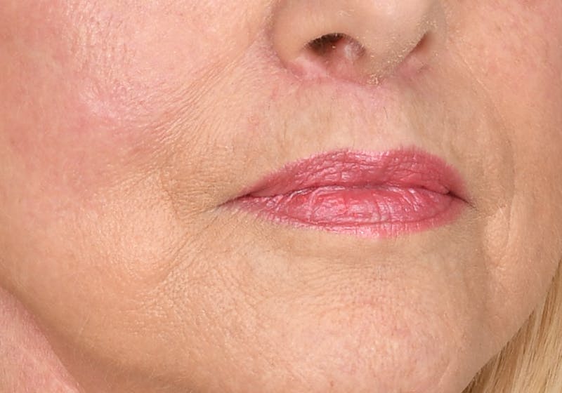 Lip Lift Before & After Gallery - Patient 429445 - Image 8