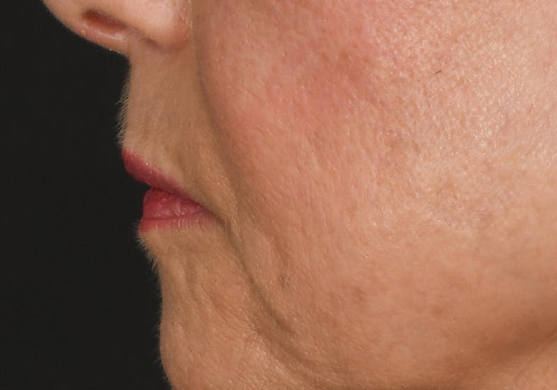 Lip Lift Before & After Gallery - Patient 429445 - Image 9